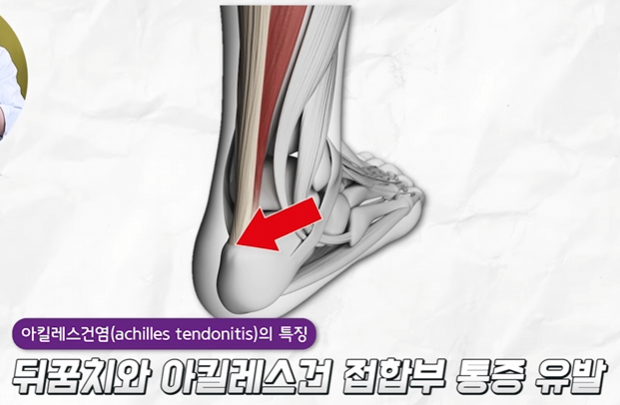 아킬레스건염