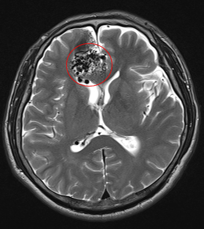 뇌 동정맥 기형 뇌출혈