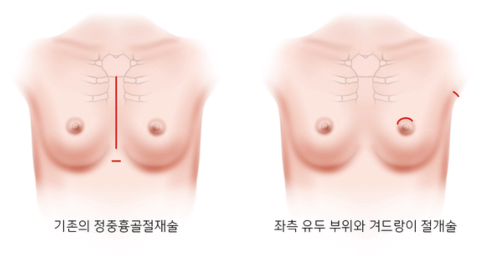 최소침습수술법