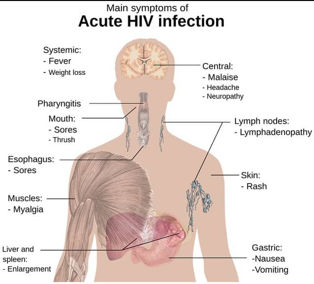 HIV 에이즈