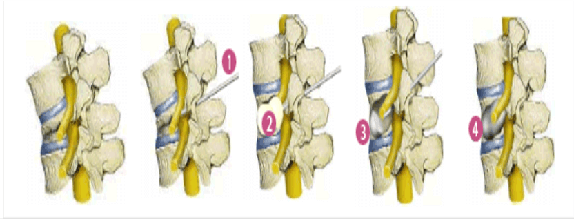 풍선척추성형술