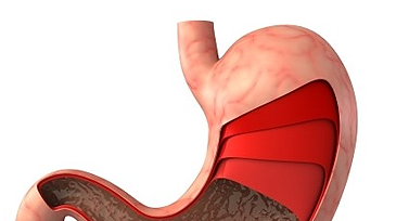 위식도역류질환 증상1