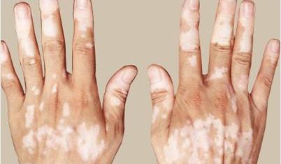 백반증-증상-유전성-진단-치료-명의-리스트