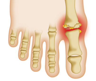 엄지발가락이 빨갛고 부음