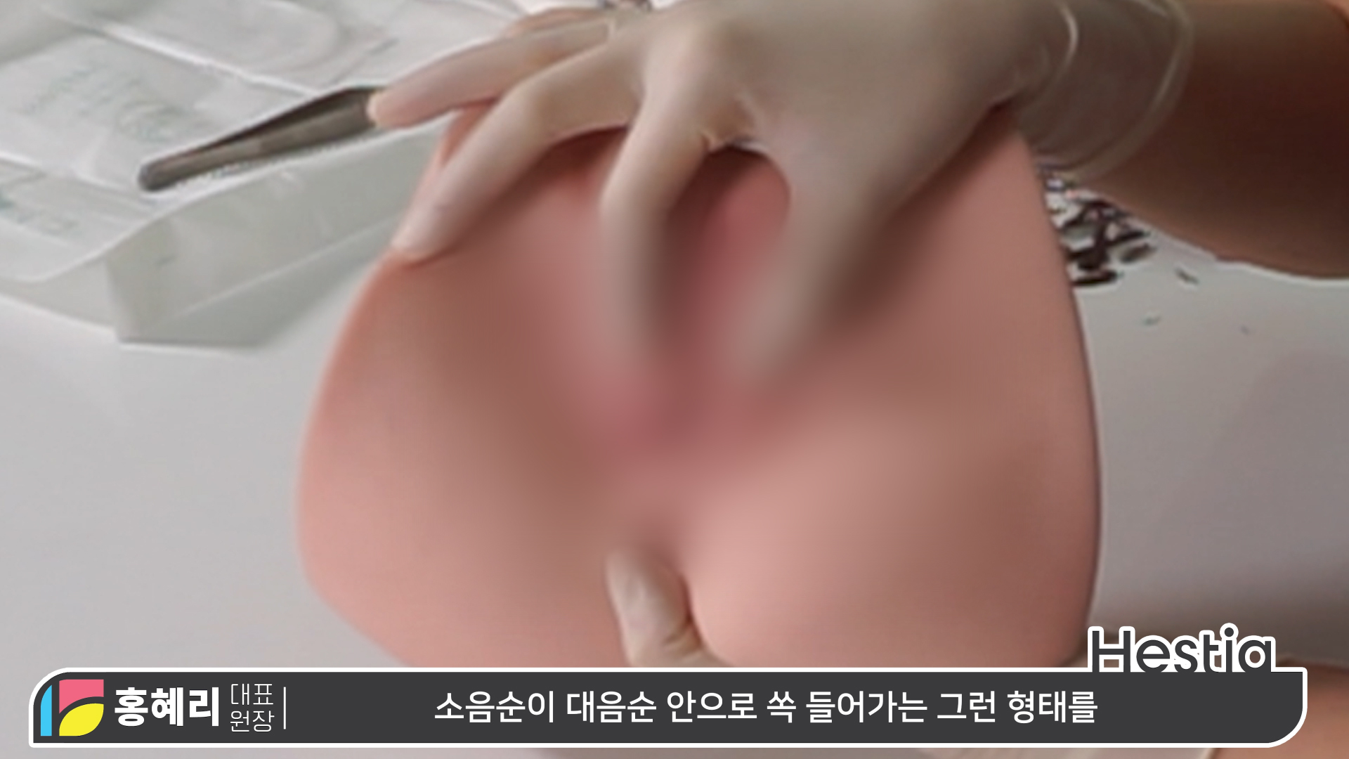 소음순성형수술 과정 대.공.개 ※수술 시물레이션 포함!