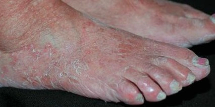 만성과각화성 발무좀 (Moccasin type)