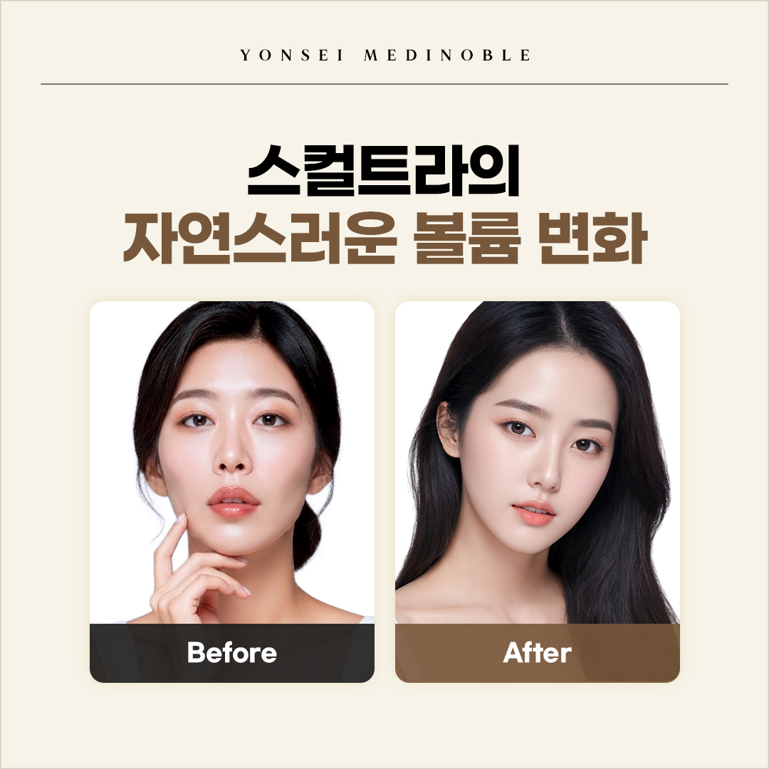 꺼진 볼에 자연스러운 볼륨 시술