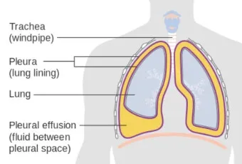 폐에 물이 차는 원인 증상 물참 관리 포인트에 대한 건강정보_9