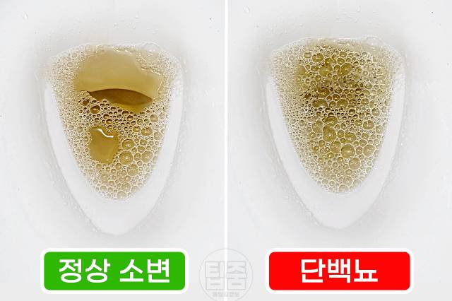 소변거품 어느정도 요독증 증상 단백뇨