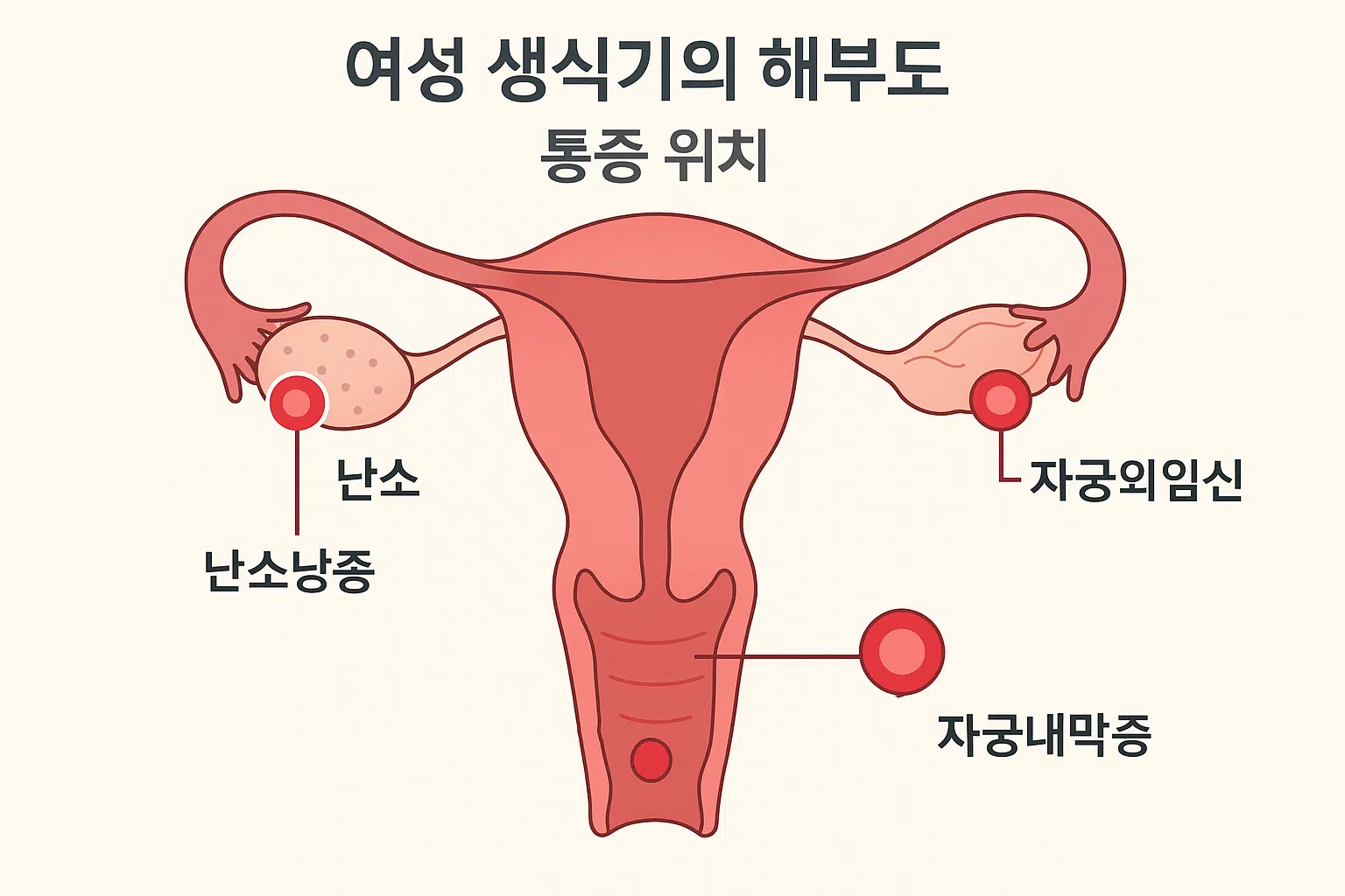 여성 생식기의 해부도(난소, 자궁, 나팔관 강조). 난소낭종, 자궁외임신, 자궁내막증 등과 관련된 통증 위치