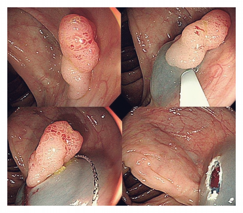 대장내시경-약-복용법