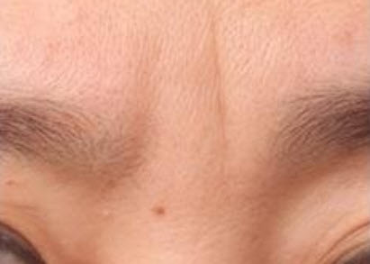 미간주름 차단술 수술 전