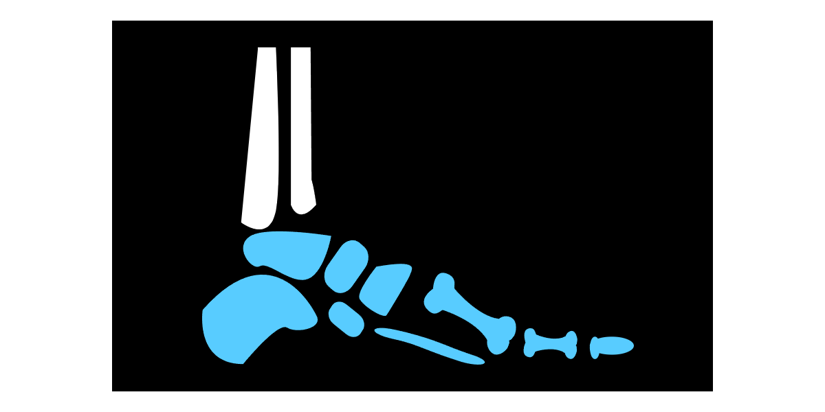 족저근막염 원인과 증상