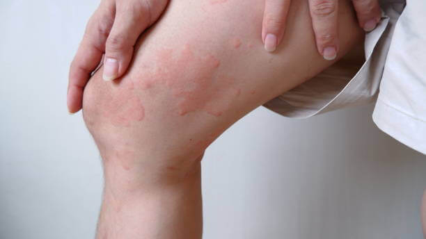갑자기 생긴 허벅지 두드러기, 그 원인과 대처법은?