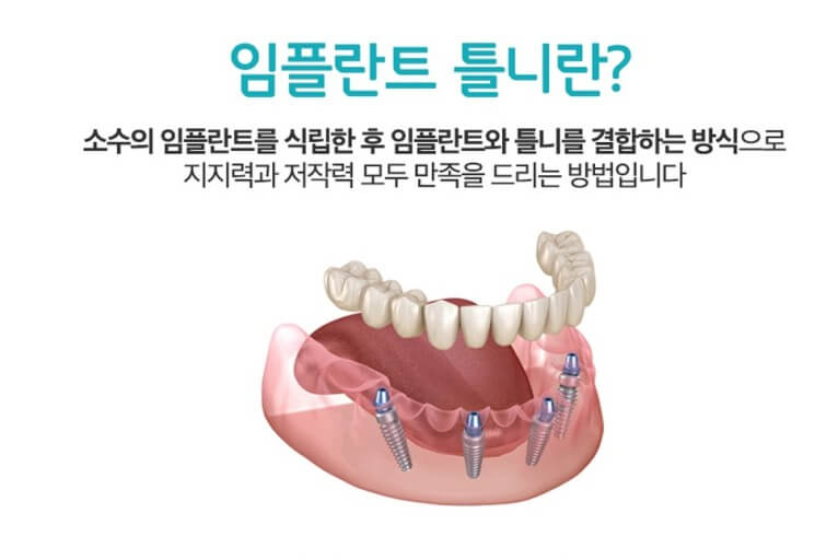 임플란트 보험 임플란트 가격 임플란트 비용 치아 보험 추천 치과 보험 추천 임플란트 치아 보험 치아 보험 적용 기과 보험 적용 치과 보험 임플란트 임플란트 치아