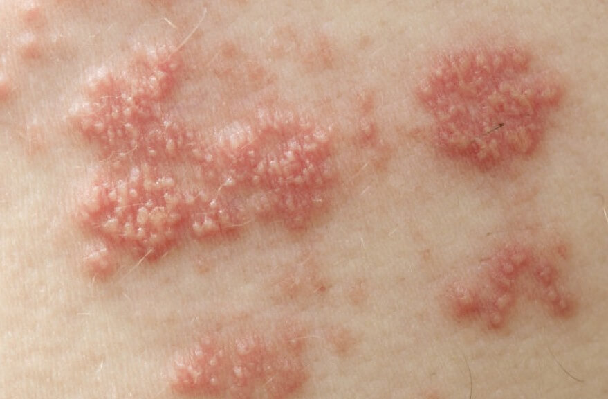 헤르페스2형에-감염된-증상으로-피부에-수포가-발생한-사진입니다.