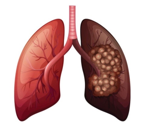 폐암이 진행된 모습