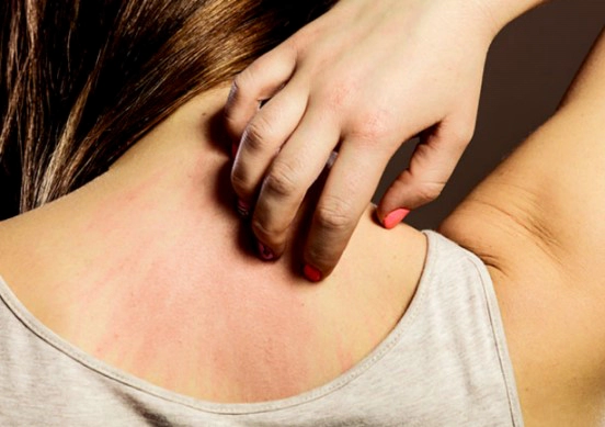 아토피 가려움증 해소방법 11가지