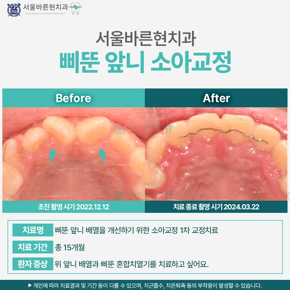부산어린이앞니교정