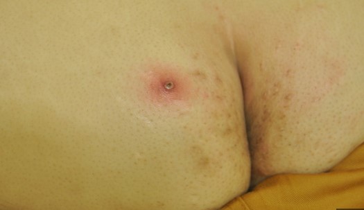 화농성 한선염 치료 방법 5가지