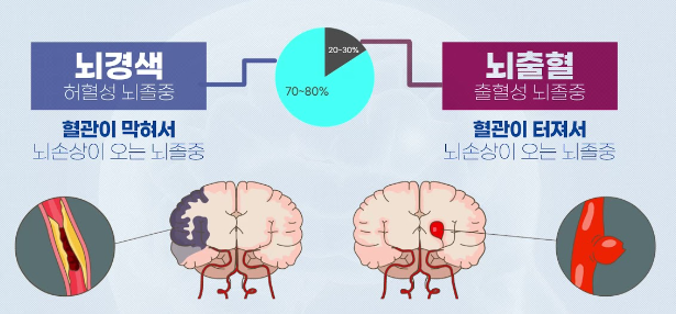 뇌졸중의 전조 증상