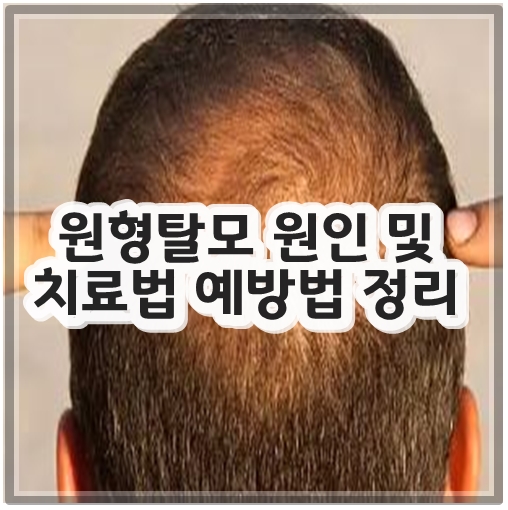 원형탈모 원인 및 치료법 예방법 정리