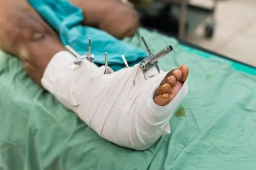 통풍이 발에 오는 이유와 증상