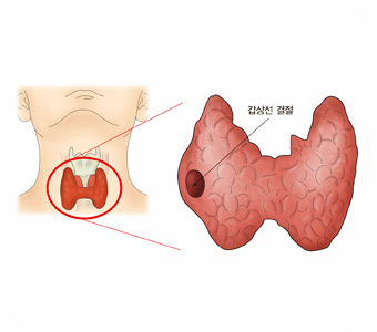갑상선-기능-저하증-증상