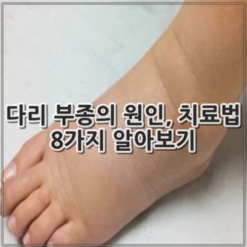 다리 부종의 원인, 치료법 8가지 알아보기