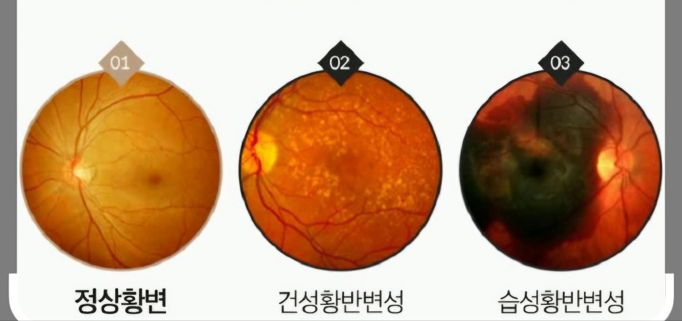 황반변성 사진예시