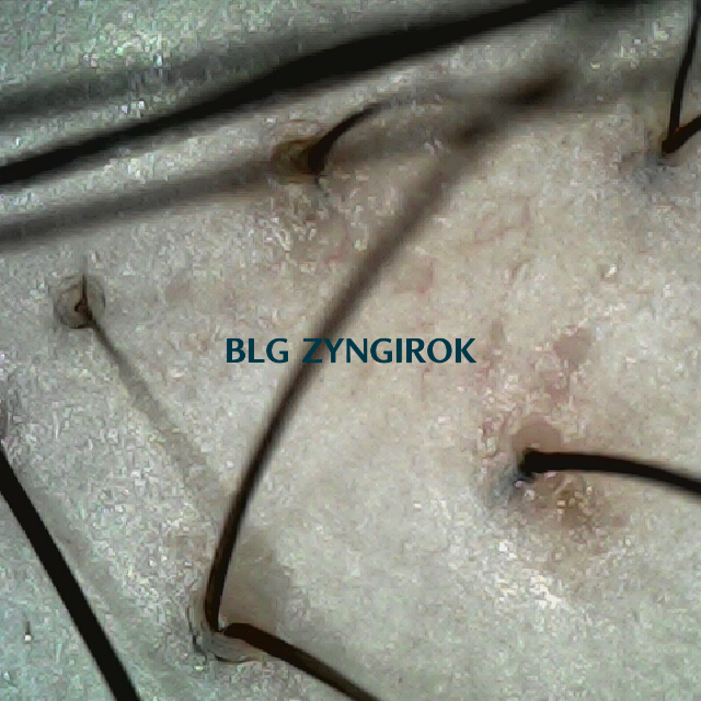 탈모 극복 프로젝트 - 정수리와 이마 사이 두피 모습이다.