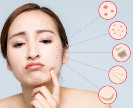 검버섯-없애는-방법