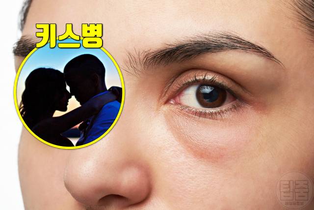 눈이 붓는 이유 눈 붓기가 안빠져요 눈붓기 원인 단핵구증