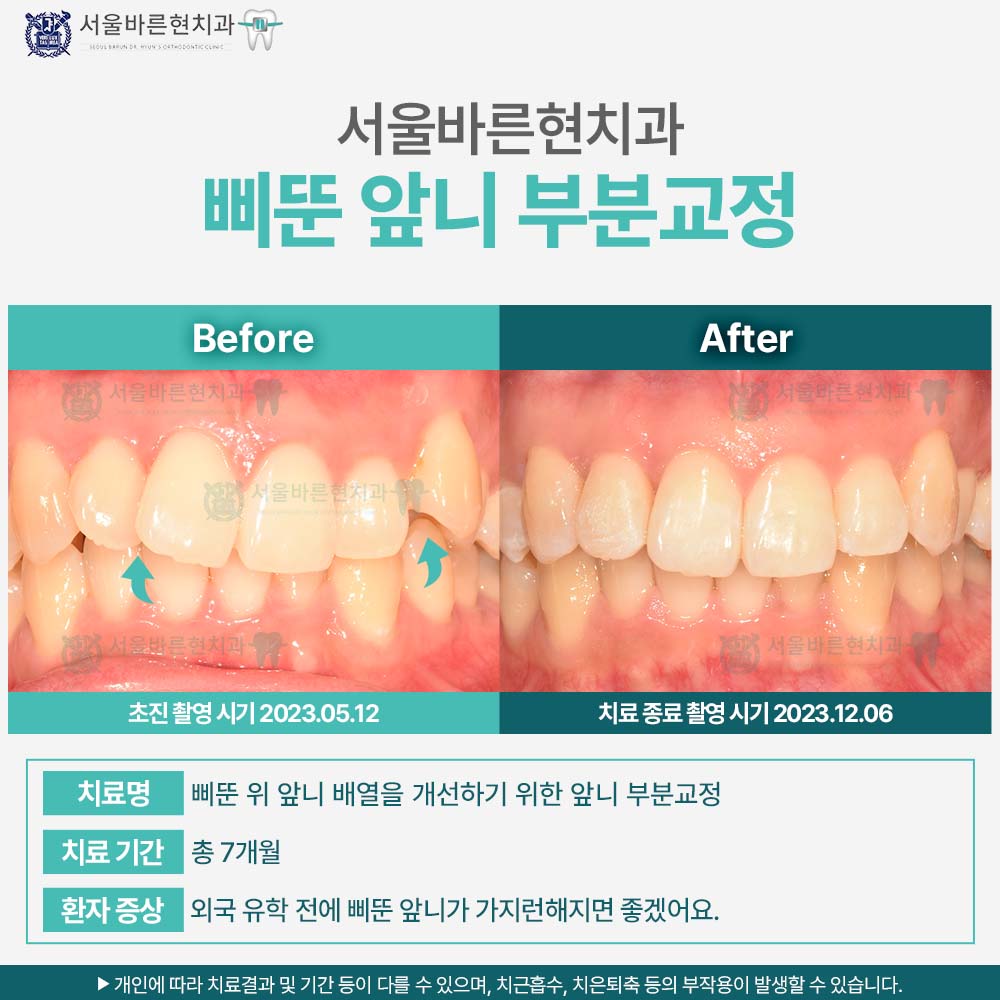 마린시티앞니교정