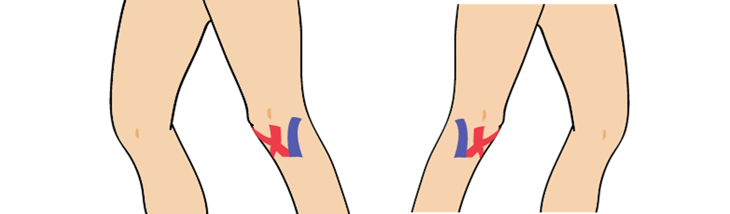 무릎 통증(외측)
