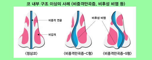 비중격 교정술 증상 및 진단 방법