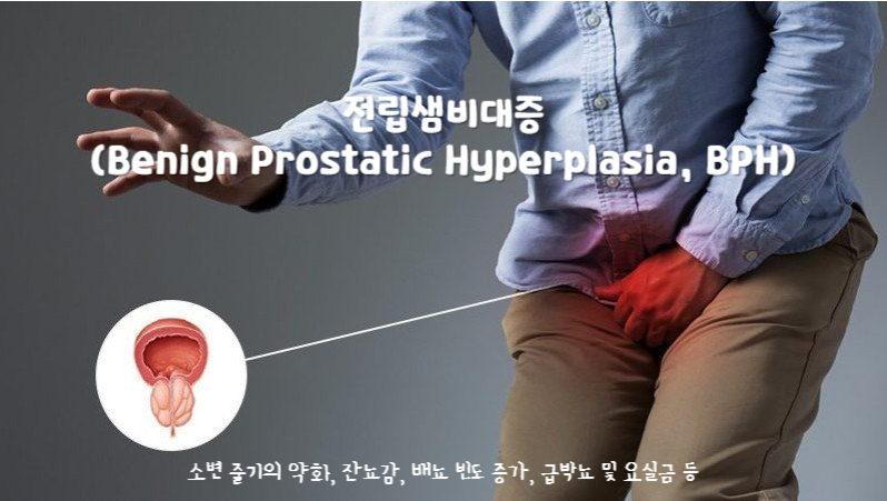 전립샘비대증(Benign Prostatic Hyperplasia, BPH)
전립샘비대증 증상 : 소변 줄기의 약화, 잔뇨감, 배뇨 빈도 증가, 급박뇨 및 요실금 등