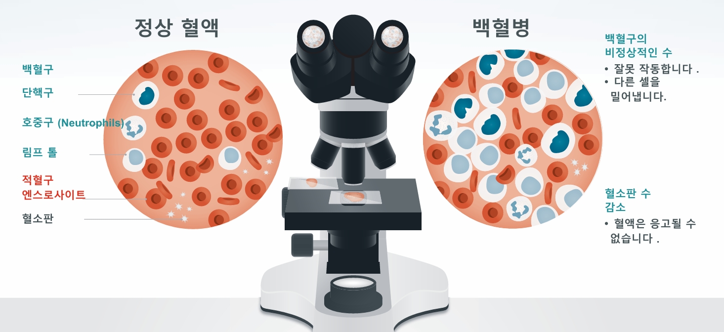 정상혈액과 백혈병 혈액의 비교