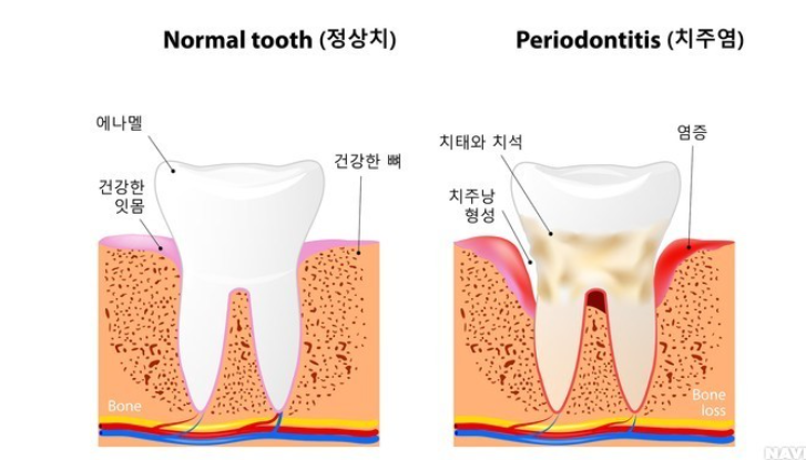 치주질환(출처 : 서울대학교 의학정보)