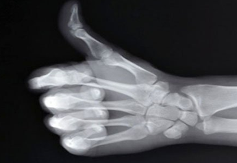 뼈 건강에 좋은 습관