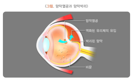 망막열공