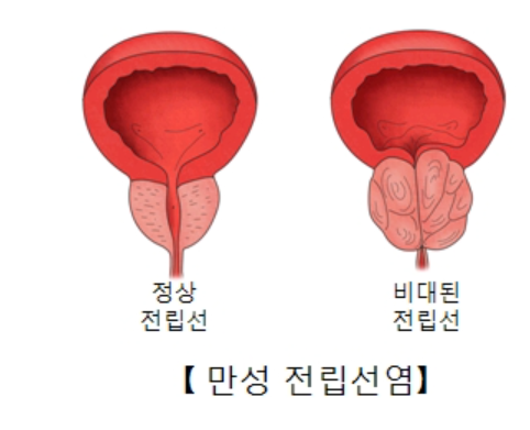남성암 대표 전립선암, PSA 검사 바로보기 / 한국 남성 전립선암 치료, 증상, 검사