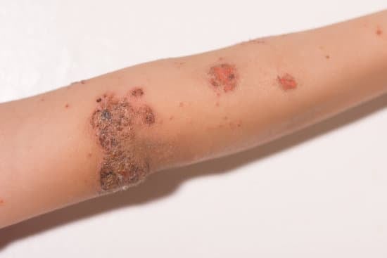 농가진 (Impetigo) &ndash; 원인, 증상, 치료법 정리