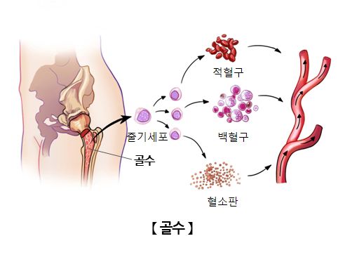 골수염이란