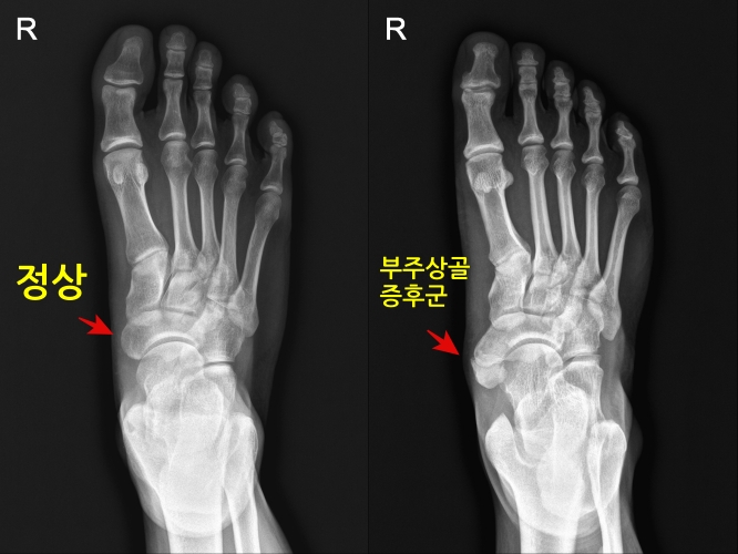 부주상골증후군x-ray-accessorynavicularxray