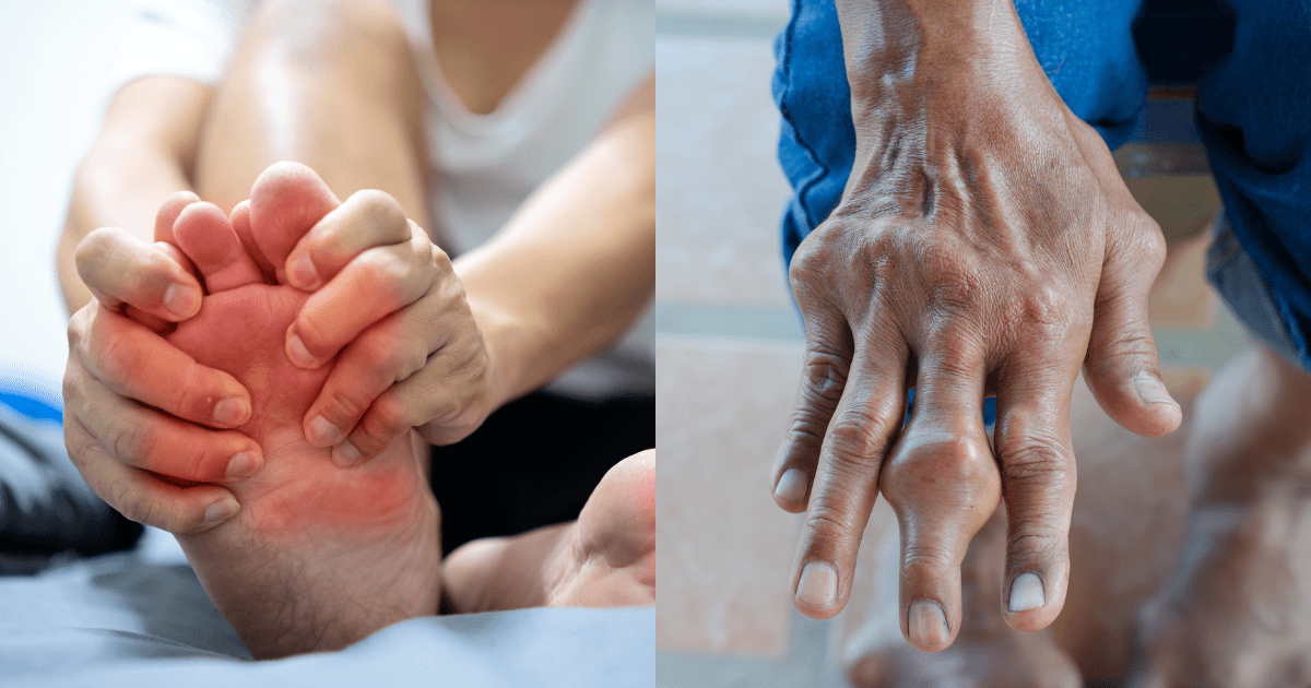 통풍 통증이 발에 와서 부여잡는 손과 손에 통풍이 와서 뼈마디가 늘어난 손