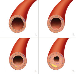 고지혈증과 콜레스테롤