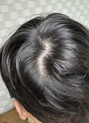 정수리가 아픈 이유와 완화하는 방법_8