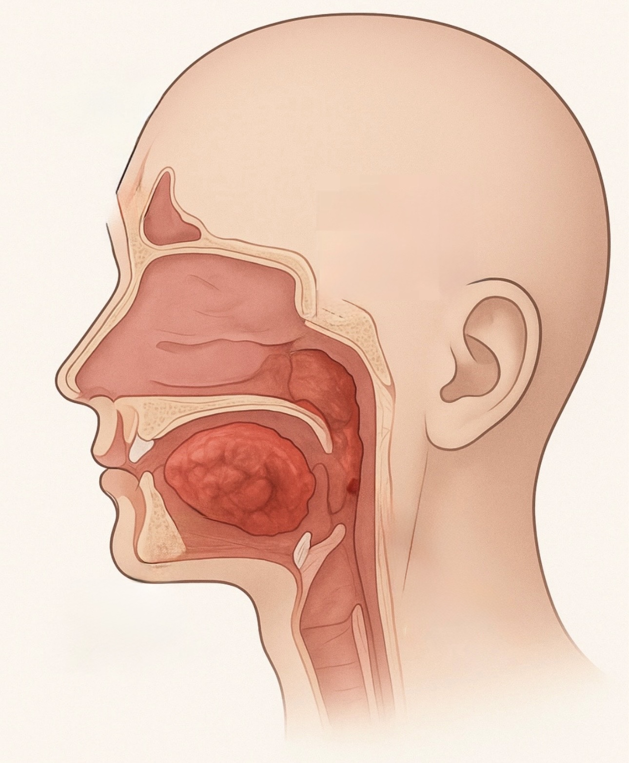 부비동암 관련 이미지