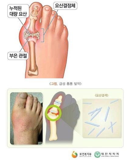 통풍에 좋은 음식-요산수치 낮추는법